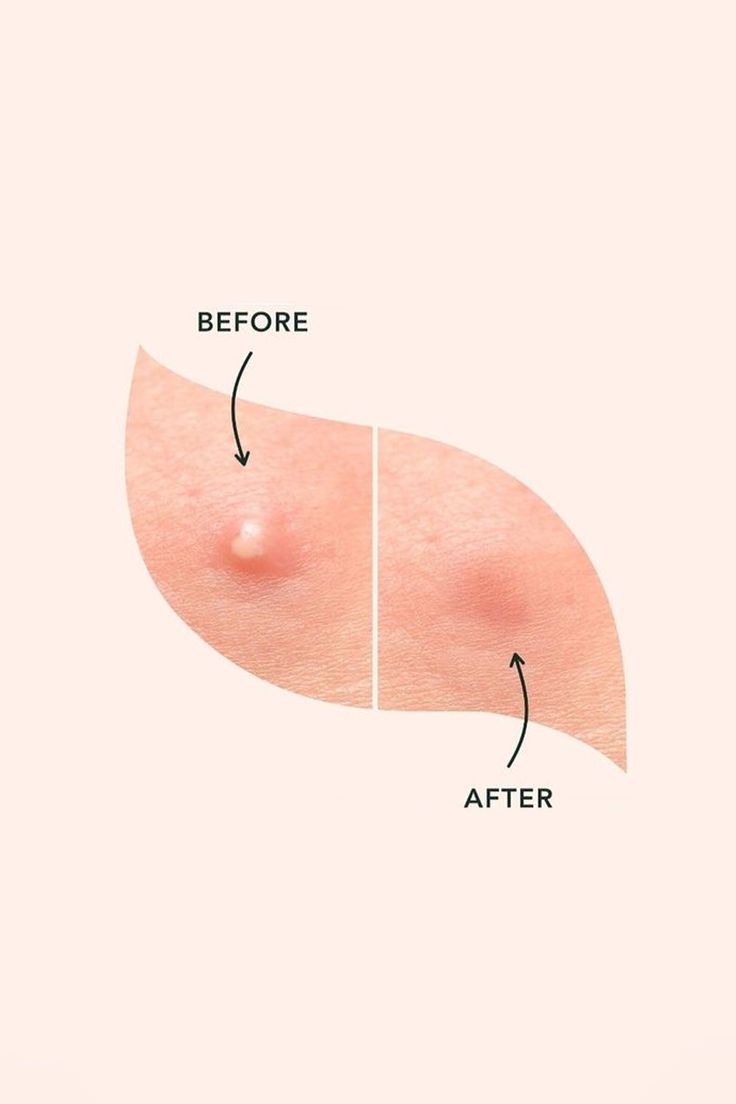 COSRX Acné Pimple Master Patch